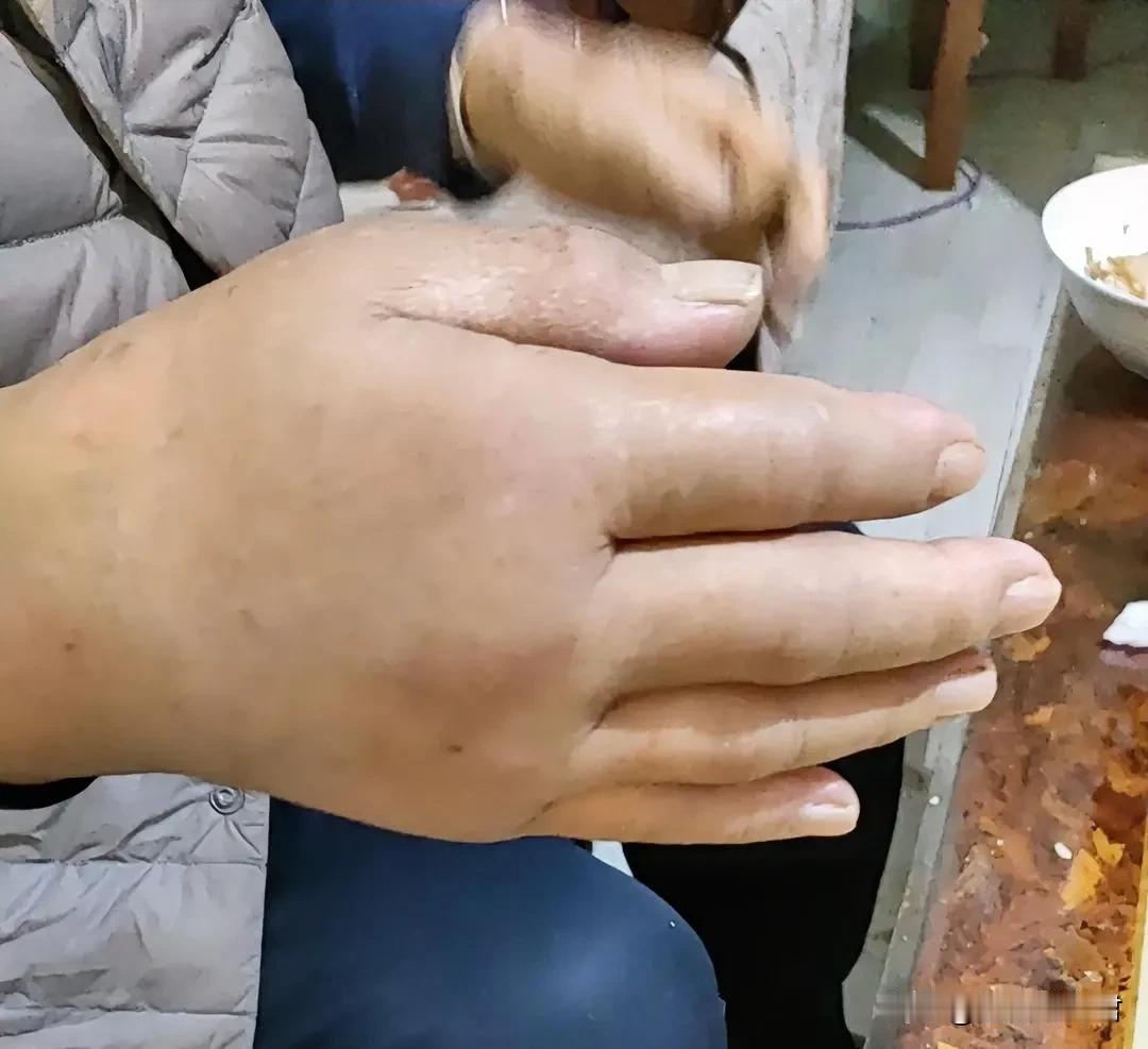 娘又偷摸着把石膏拆了，可那只手还肿着！难道不疼吗？怎么胳膊肘上的伤，瘀积到手上了