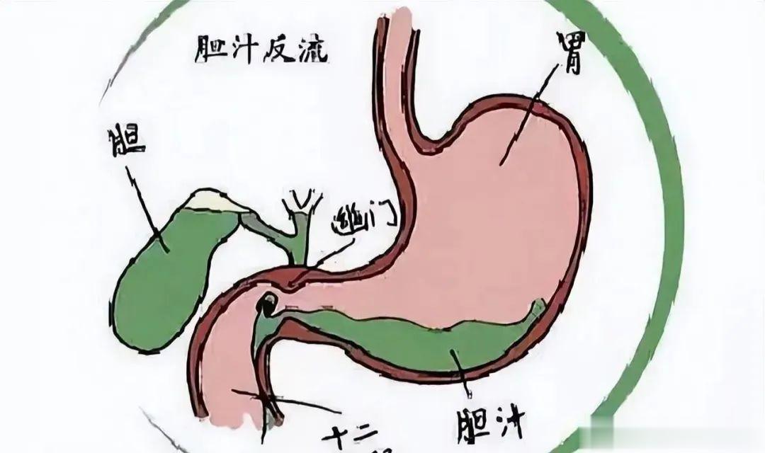 一个民间验方，轻松解决反流性胃炎食管炎，反酸 烧心 溃疡统统搞定[赞]#论道岐黄