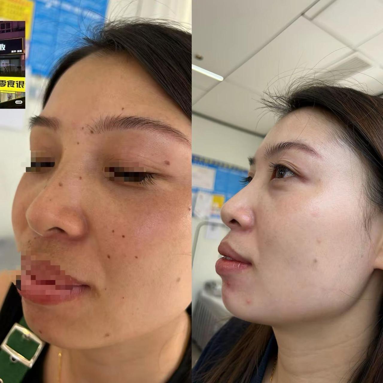 集合，麻麻点点痘痘逆袭