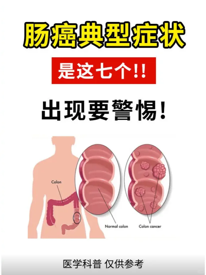 肠癌会有这7个典型症状，出现要警惕！