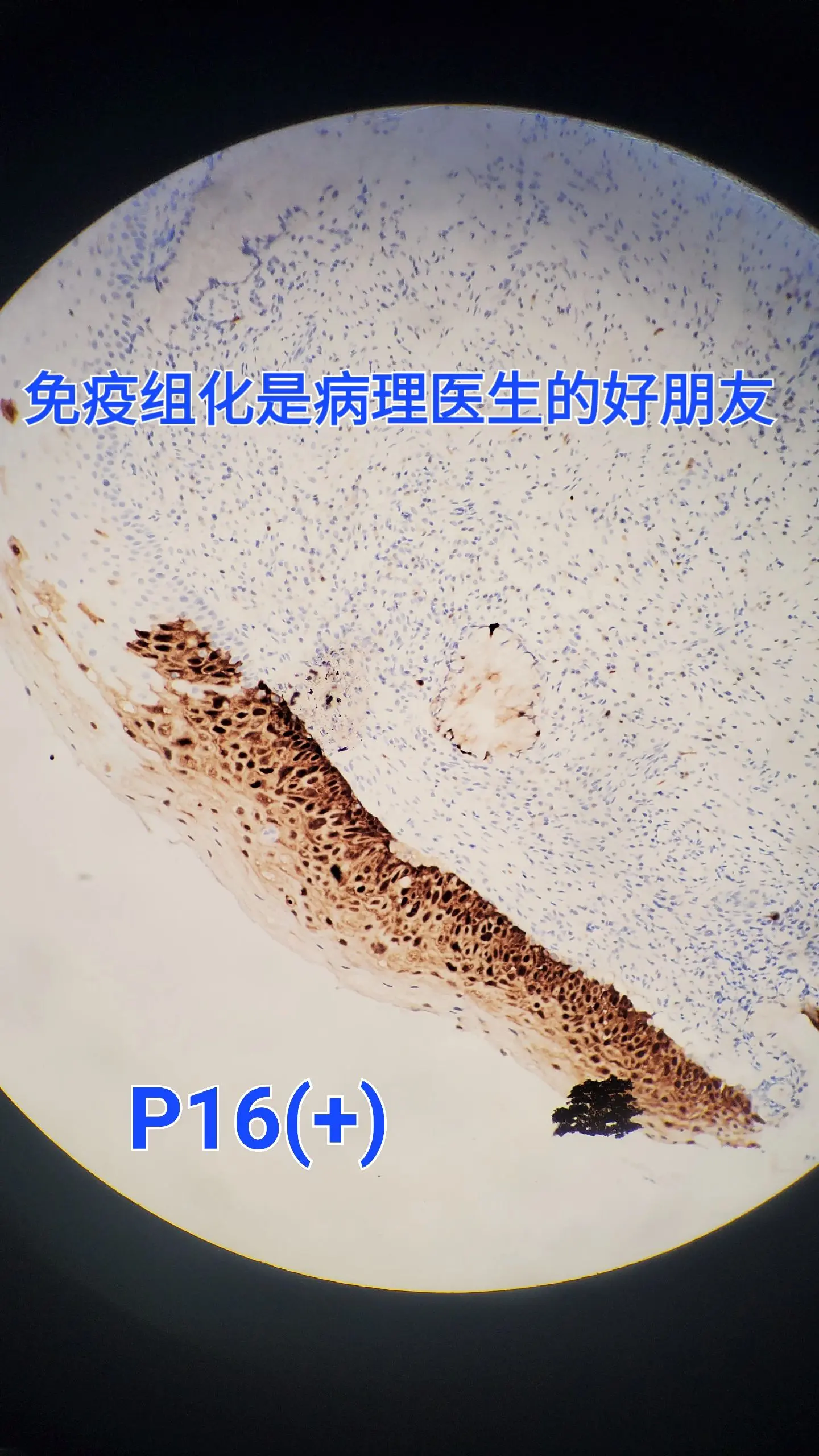 hpv感染  免疫组化