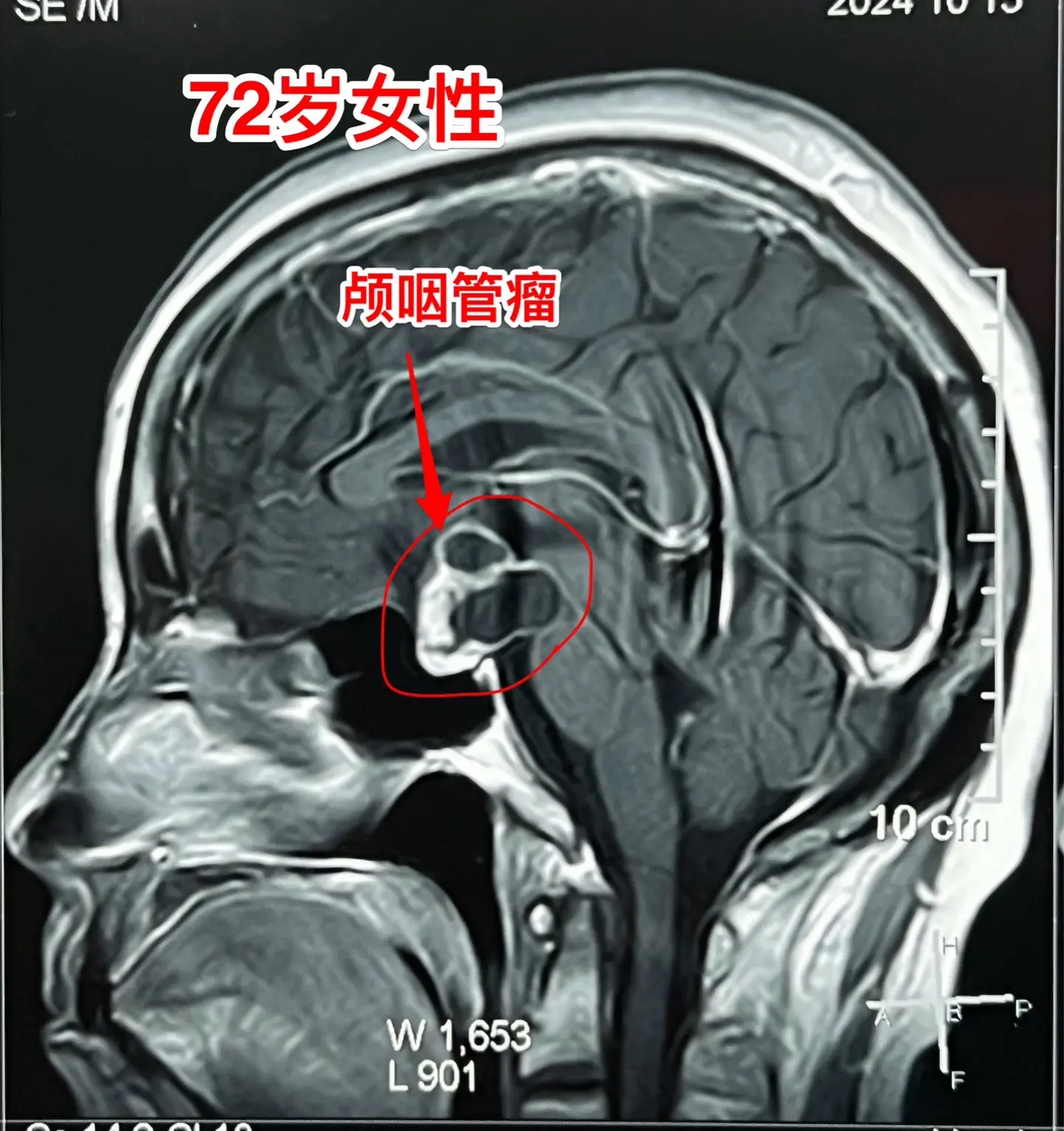 颅咽管瘤不单单是小孩子得的病！很多人认为颅咽管瘤是小孩子得的病，其实各...