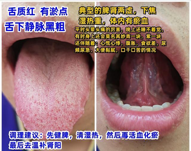 今日舌诊案例分析，看看你能从自己的舌头上看出什么问题吗？[给力][给力][给力]