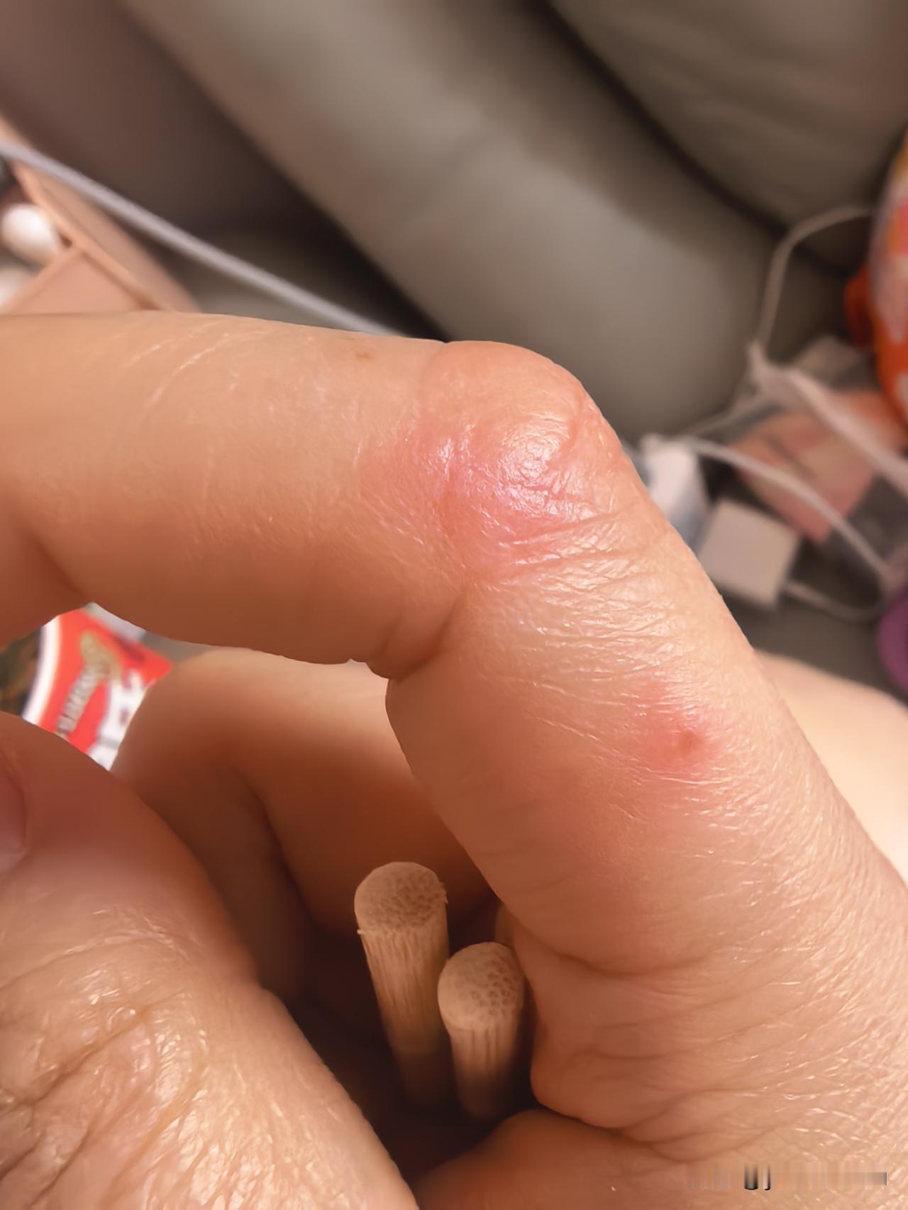 这长得什么，小水泡，奇痒无比，十几天了不好