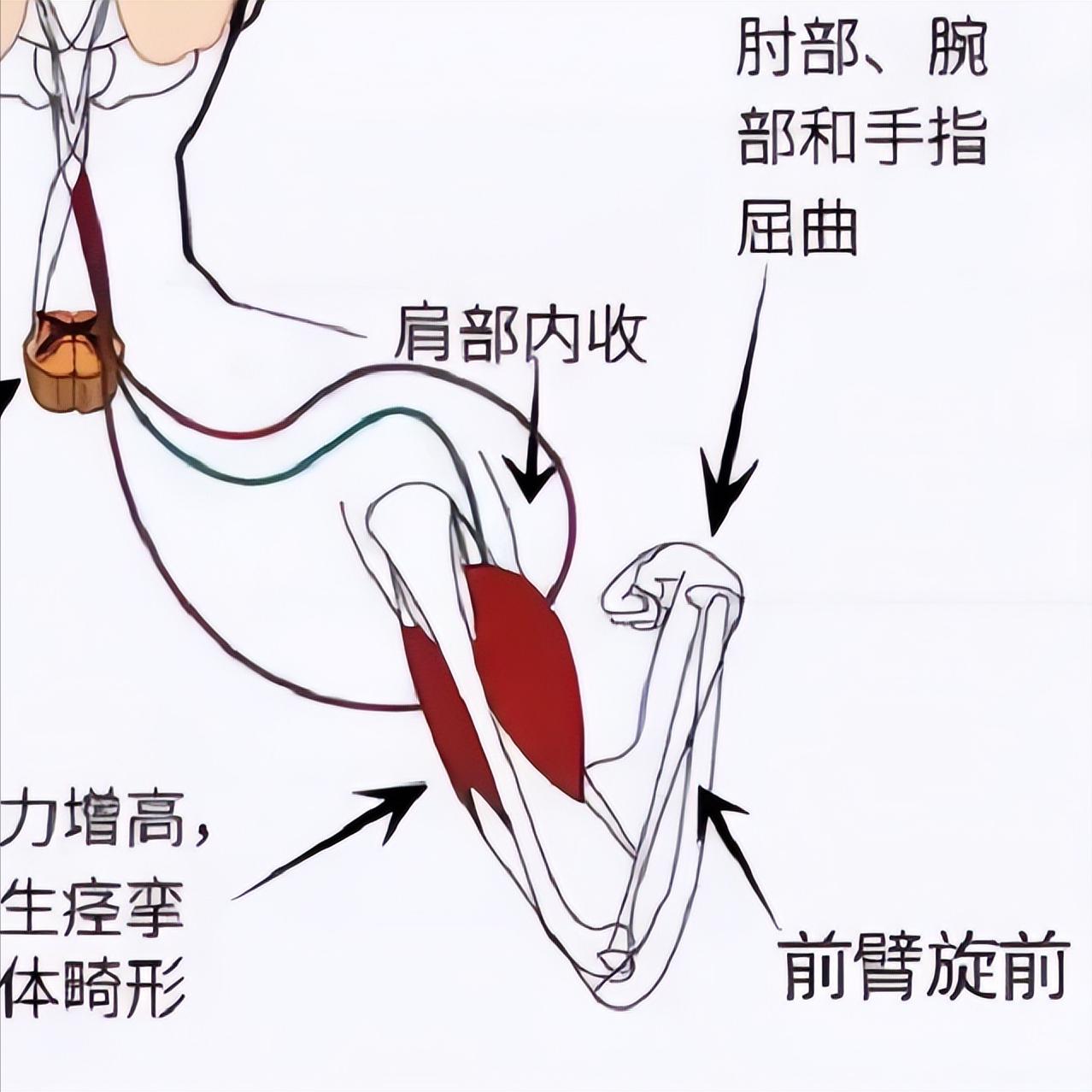 偏瘫后手臂伸不直？别硬拉，三个动作慢慢来

一、被动伸展
患者平躺或坐稳后，自己