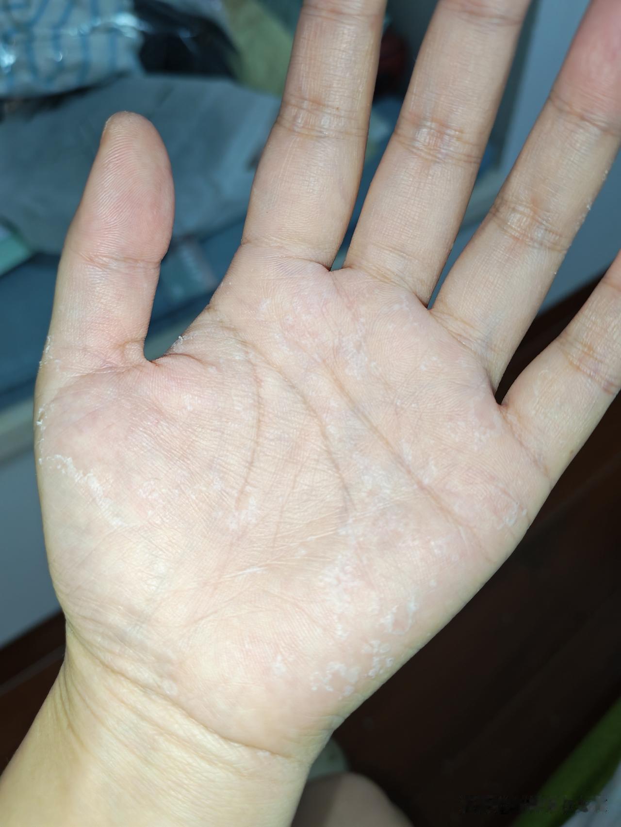 今天是我第二次化疗后的第六天，我终于又活过来了，这次化疗换了药水后副作用太大了，