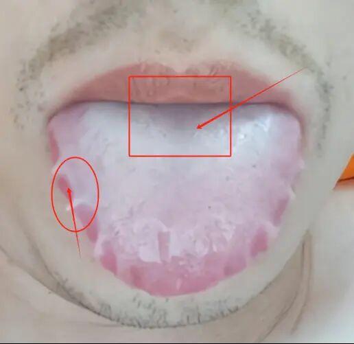 齿痕舌显露，温阳治疗是关键
主诉描述：身体状态不佳，精神萎靡，起身困难，且每天早