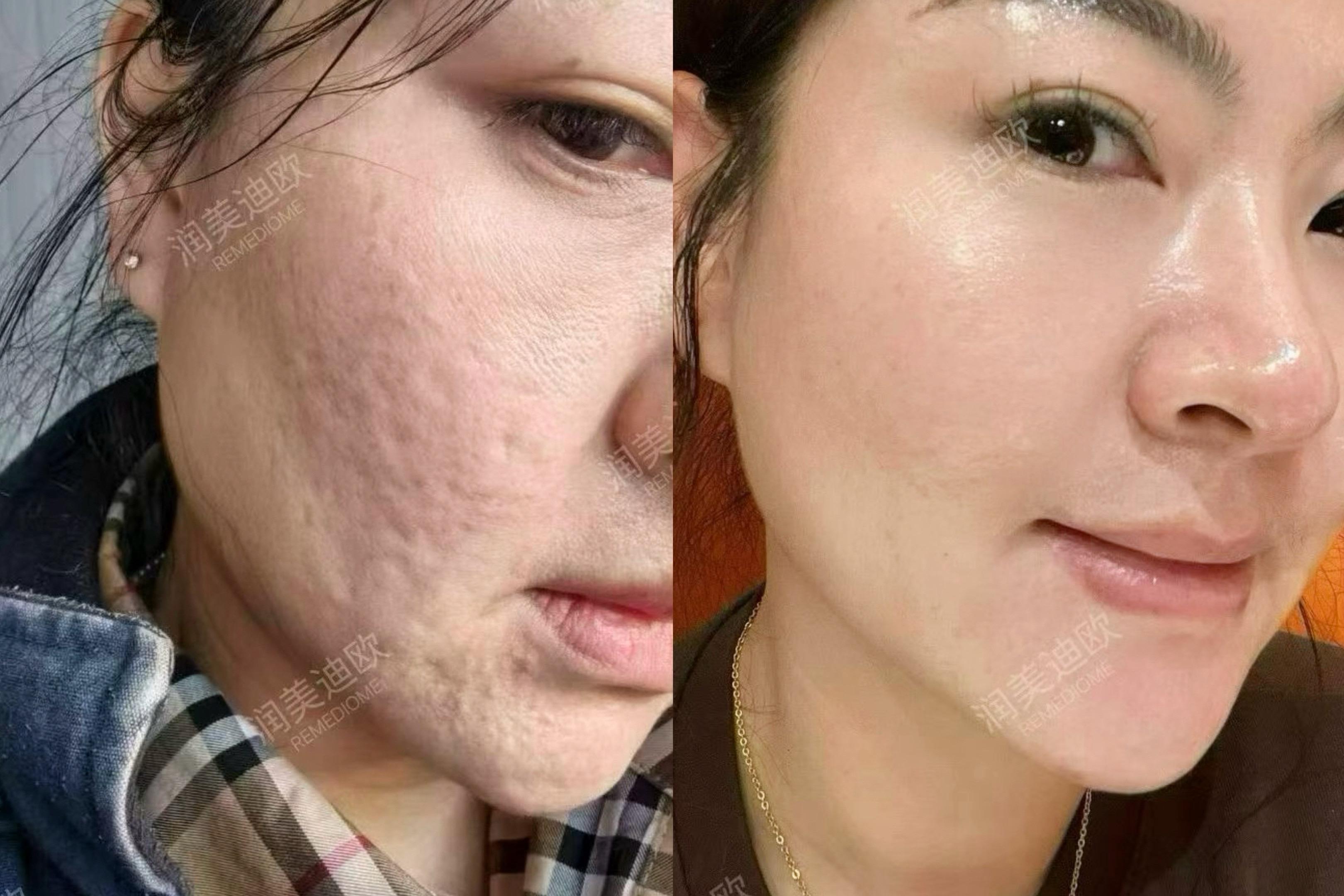 没错 只是换了一套护肤品 我们都是REMEDIOME的受益者♥️ 自己...