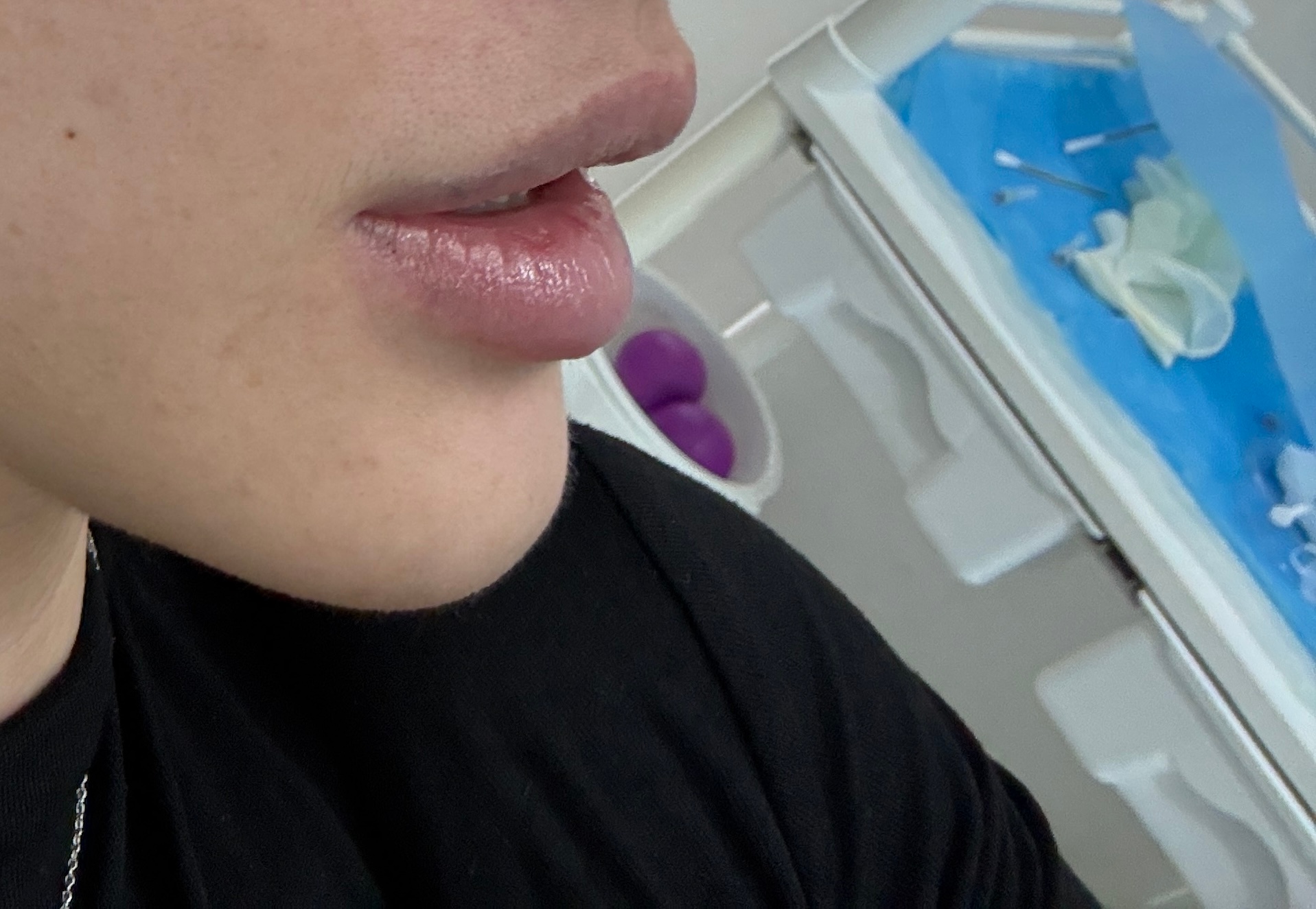 💉红唇内卷真的改善好多啊1ml 的效果！建议内卷的人都找王院打！我打的瑞蓝3K