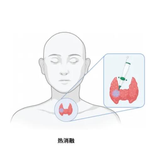 甲状腺癌选择消融，底气够足吗？