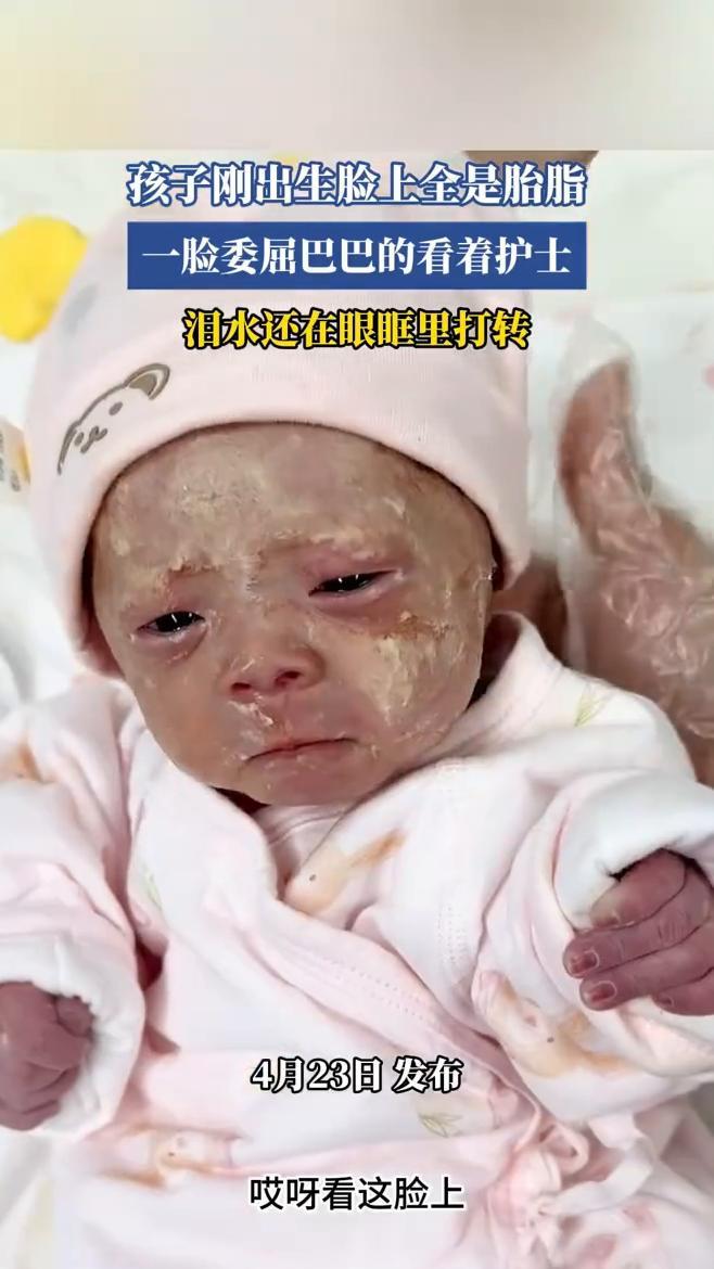 孩子刚出生脸上全是胎脂，脸委屈巴巴的看着护士，泪水还在眼眶里打转。
4月23日发