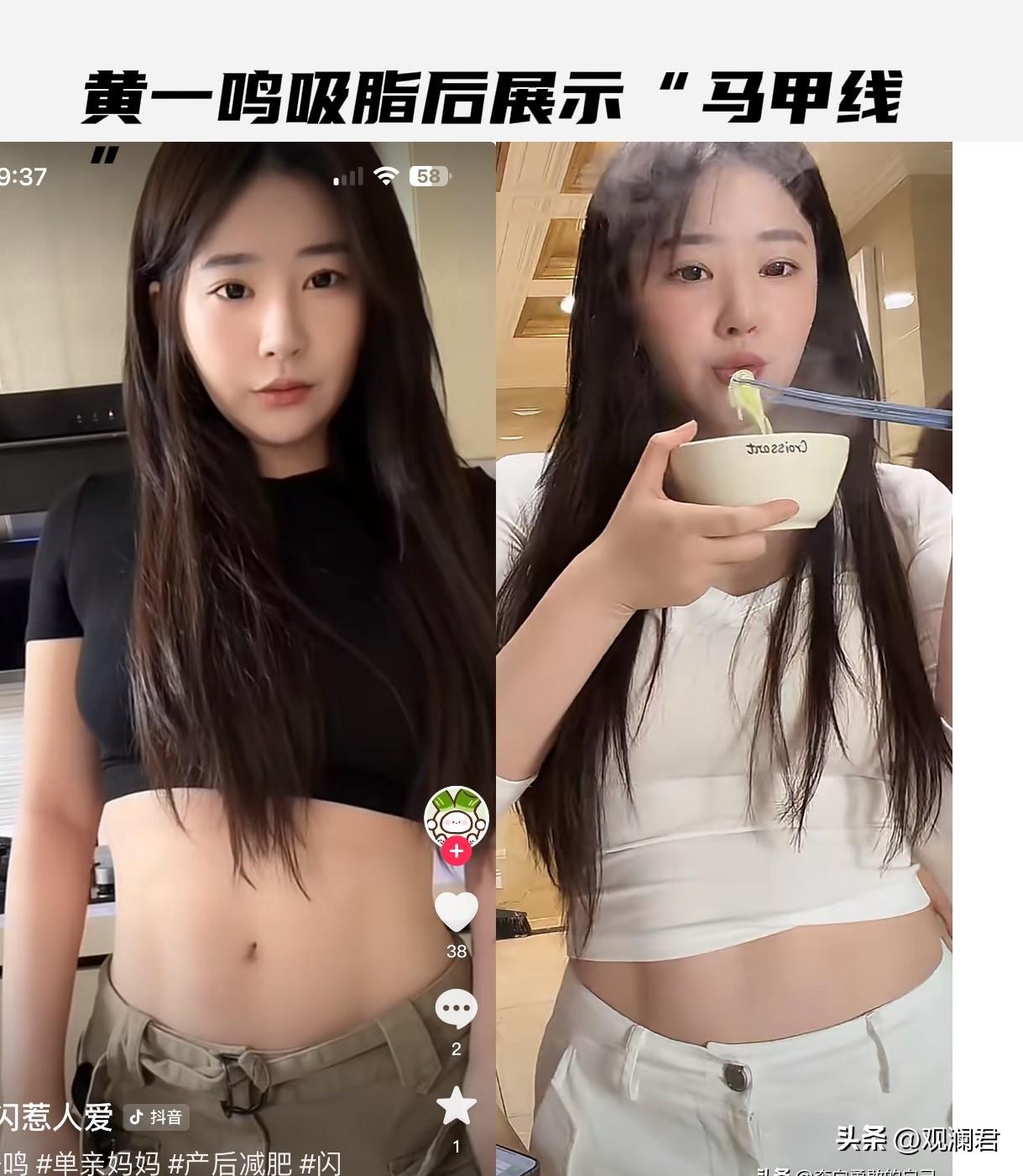 黄一鸣吸脂后展示马甲线
黄一鸣最近提到的话题多与整容塑形有关，她分享了自己的整容