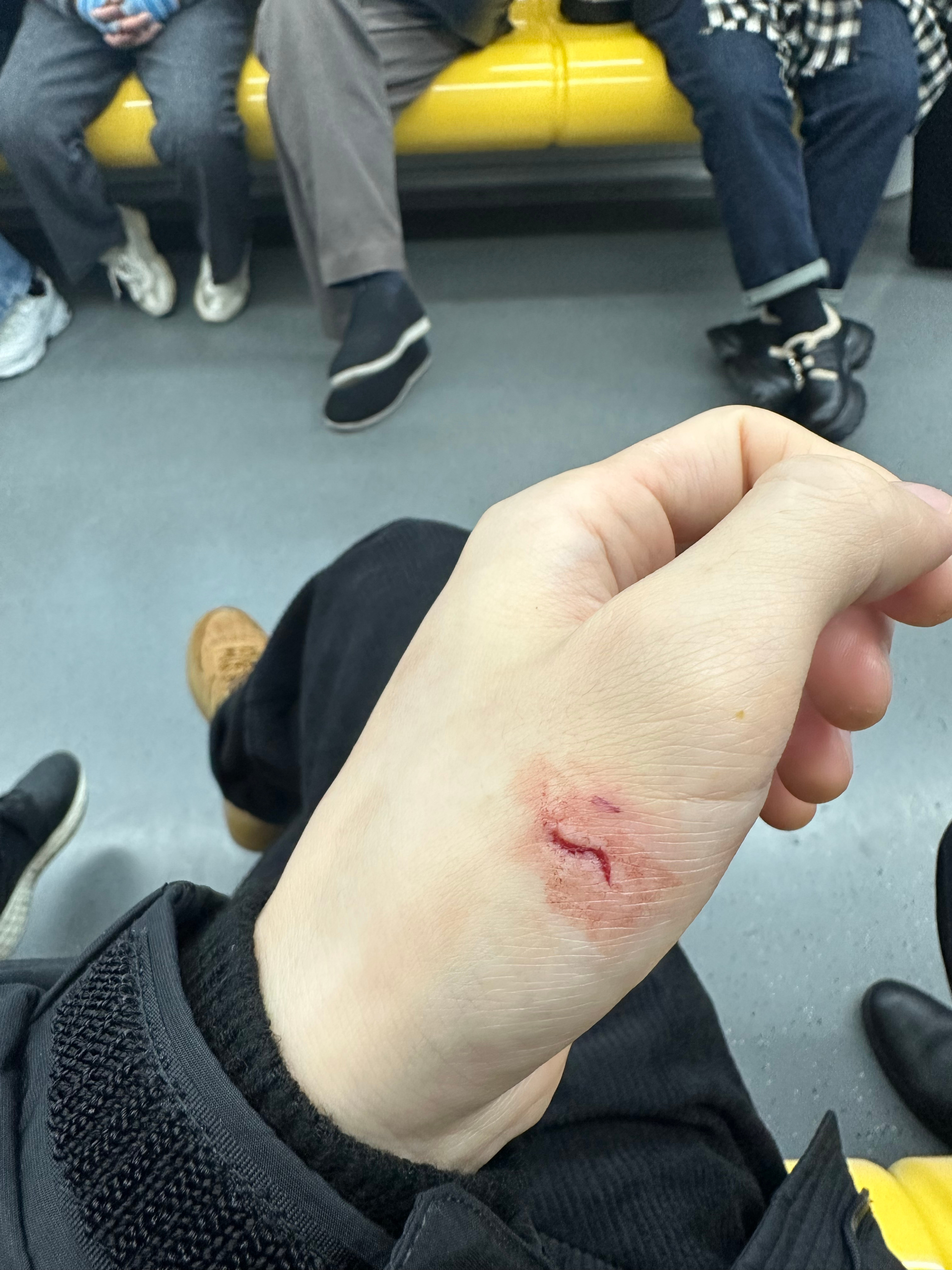 刷个碗把手给割了 这我是没想到的盘子突然就在手里碎了… ​​​