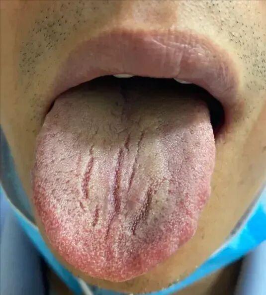 裂纹舌：不只是脾虚湿盛，还需关注阴虚与心火

舌苔黄干、舌质淡白和舌边发红，都是
