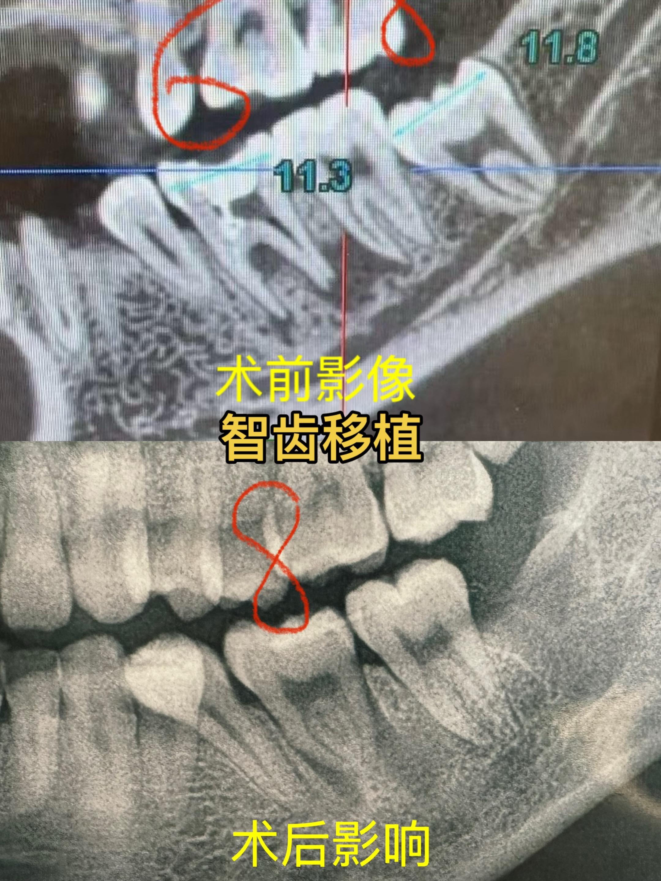 智齿移植。智齿移植一例 牙齿
