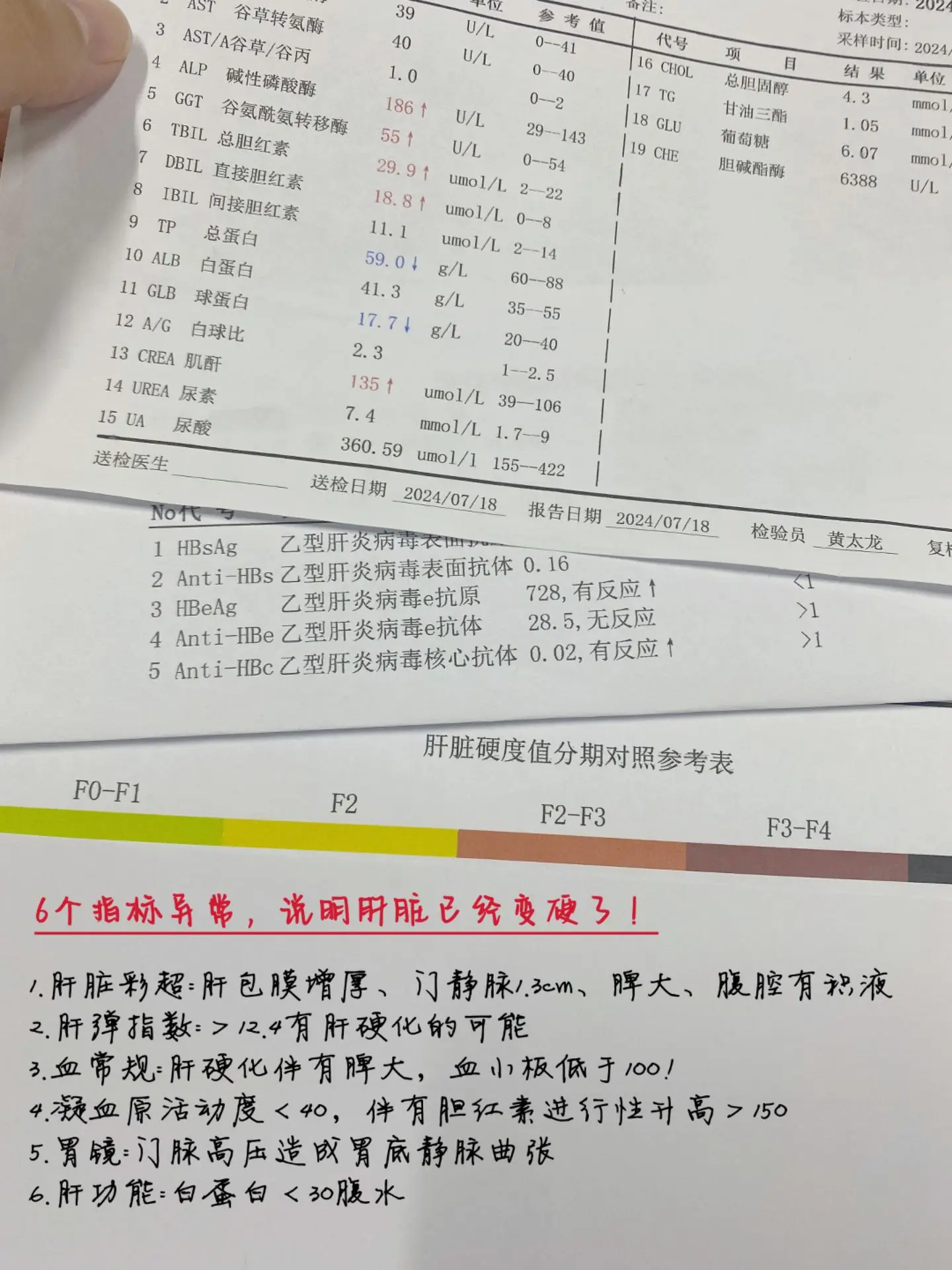 当心！6个指标异常，提示肝硬化！