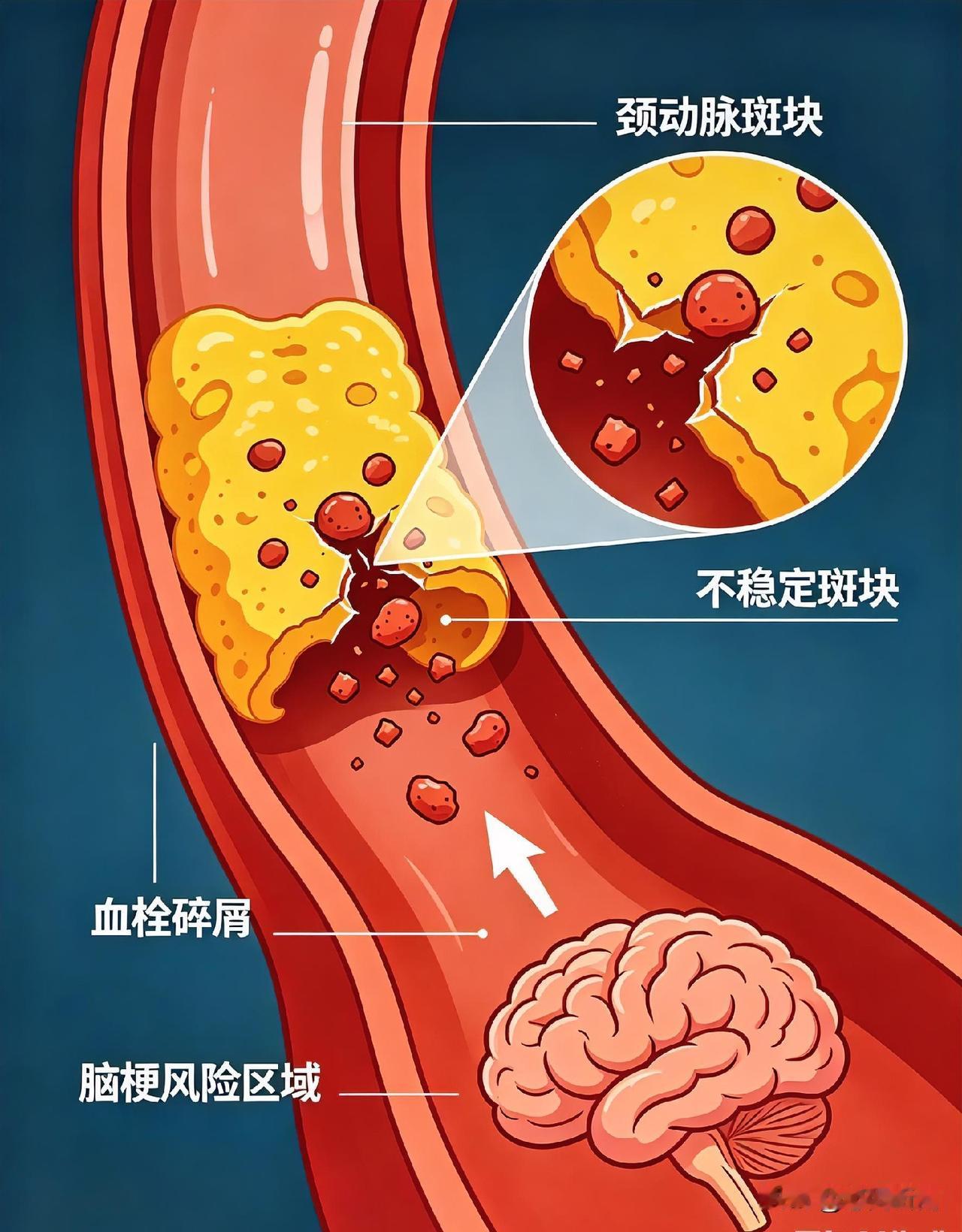 血管长了斑块，脱落风险大不大？弄懂这点，远离脑梗
 
很多中老年人体检都会查出颈