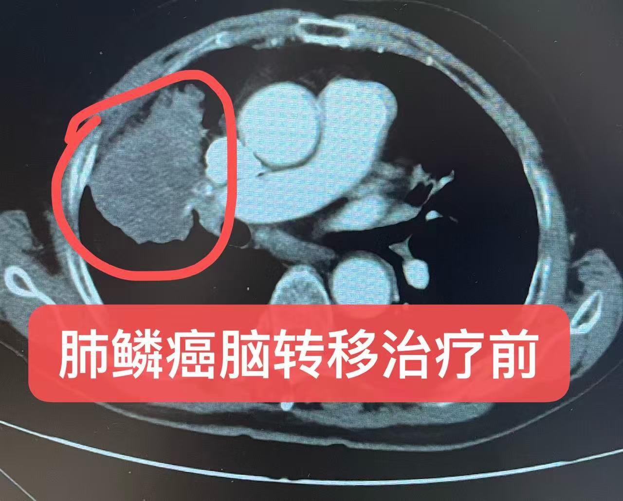 肺鳞癌脑转移。肺鳞癌，多发脑转移的治疗！ 患者男，72岁，头晕一周入院...