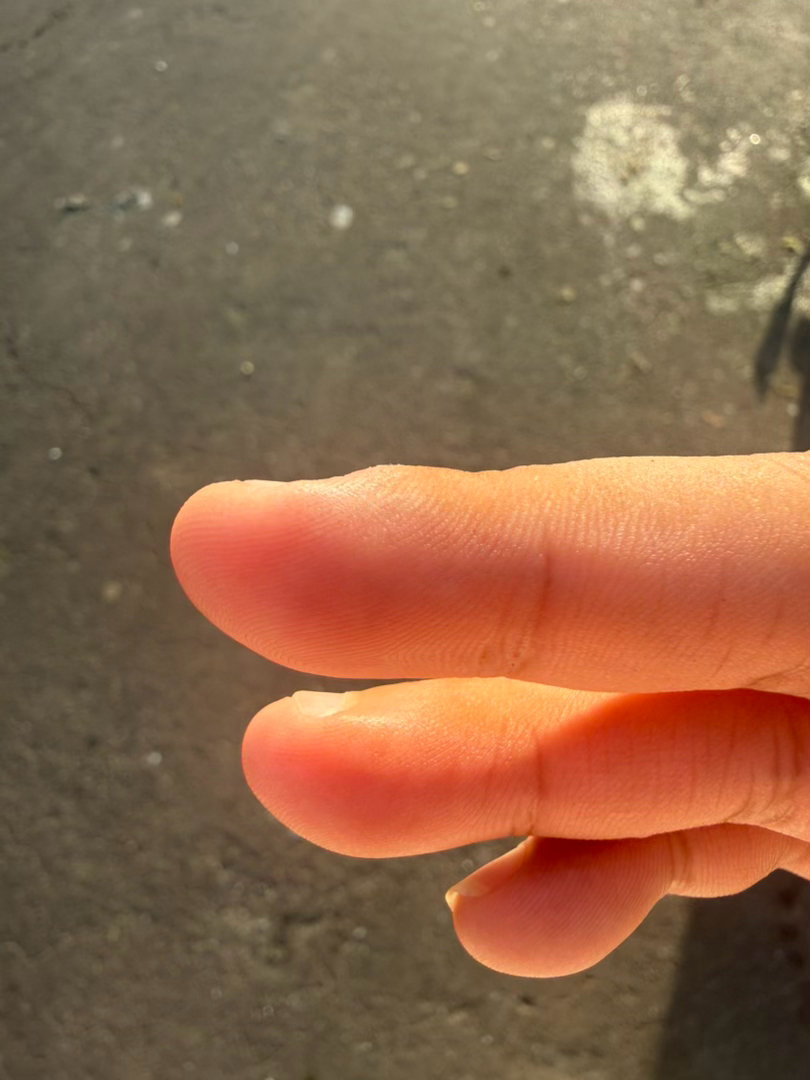 现在这个手怎么动不动过敏，虽然不是很严重吧。但是只是去菜市场买一点点菜和买了几个