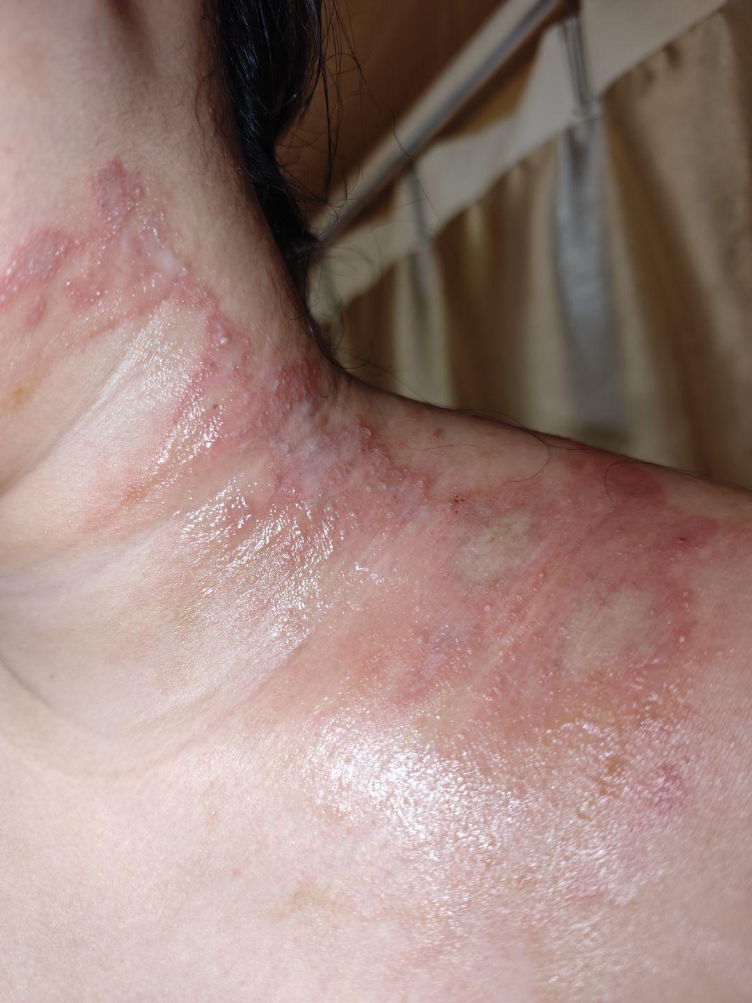 前几天夜里上厕所，没留意爬上来一只小虫，一开始我以为只是蚂蚁。没过多久皮肤就开始