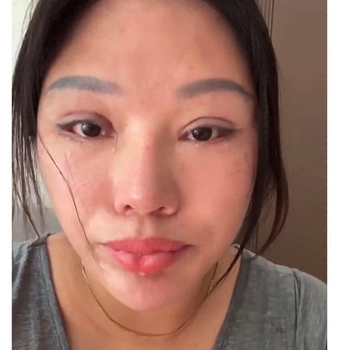 “必须严惩！”苏州，一名女子到熟人介绍的医美门诊，花1万多割双眼皮，没想到割了之