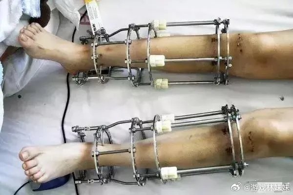 男子身高一米八二仍做断骨增高 1米82仍冒险断骨？身高焦虑催生畸形审美，拿健康赌