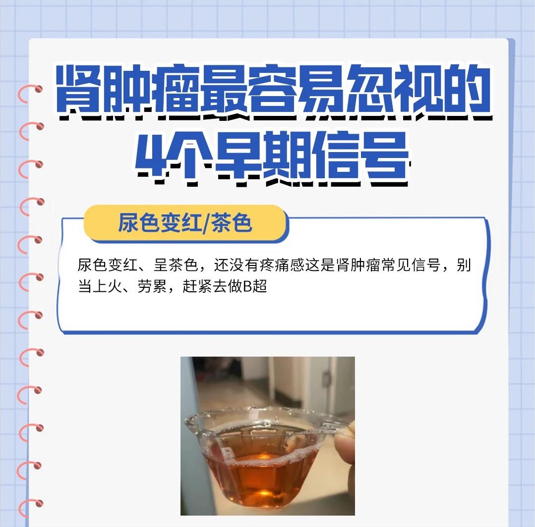 不易察觉的肾肿瘤，4 个早期信号一定要警惕