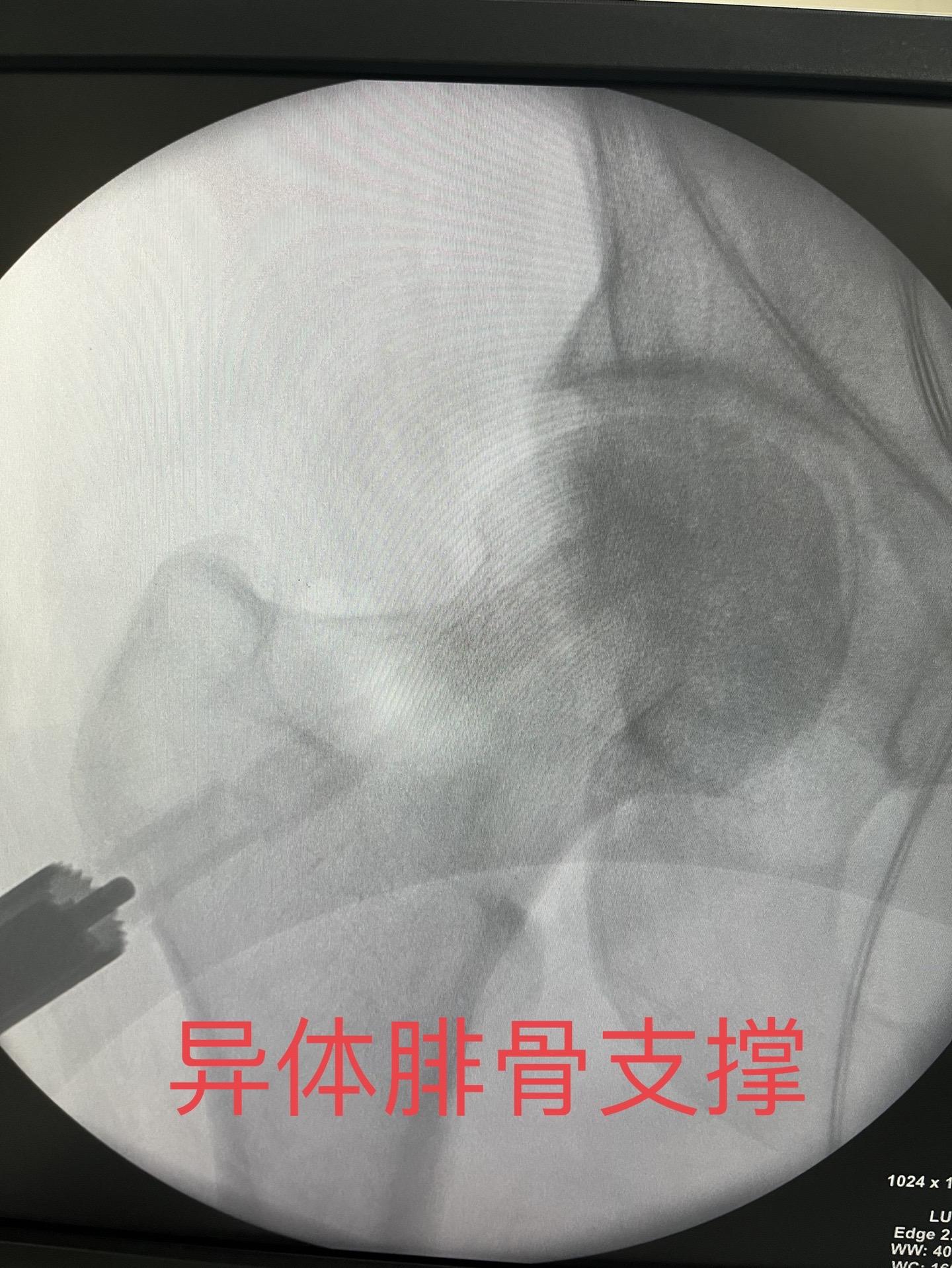 31岁酒精性股骨头坏死术后四个月复查，股骨头坏死打压植骨异体腓骨支撑，四个月复查，可见植骨已生长，患者无疼痛，关节功能活动自如。