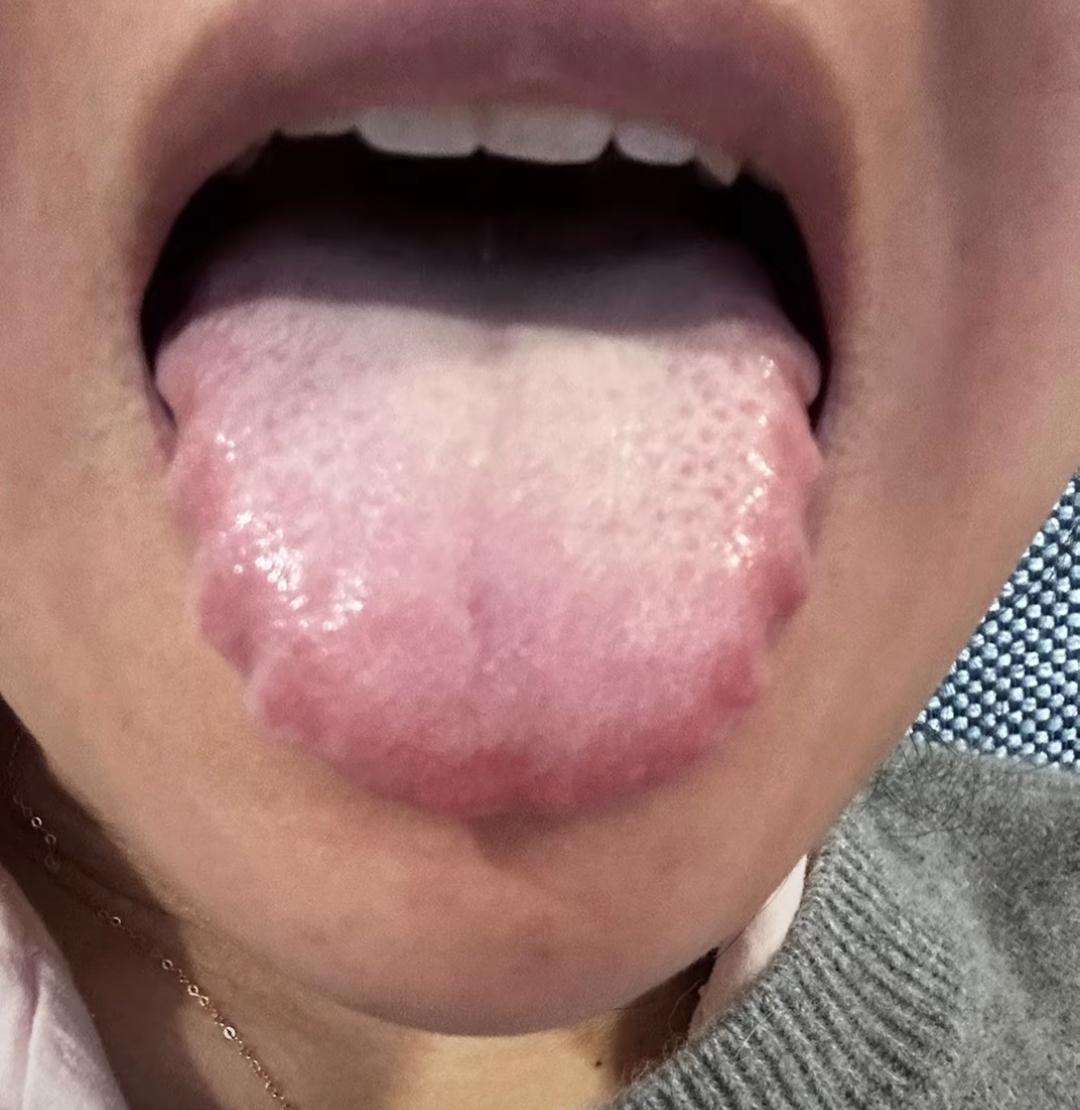 碰见这样的齿痕舌，身体都堵了，湿气重才是小事[紫薇别走]
你还在傻傻祛湿气，健脾