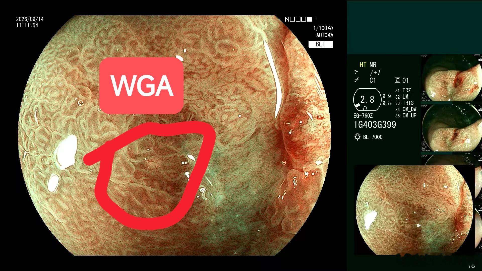 WGA（White Globe Appearance，白色球状外观）核心要点病理