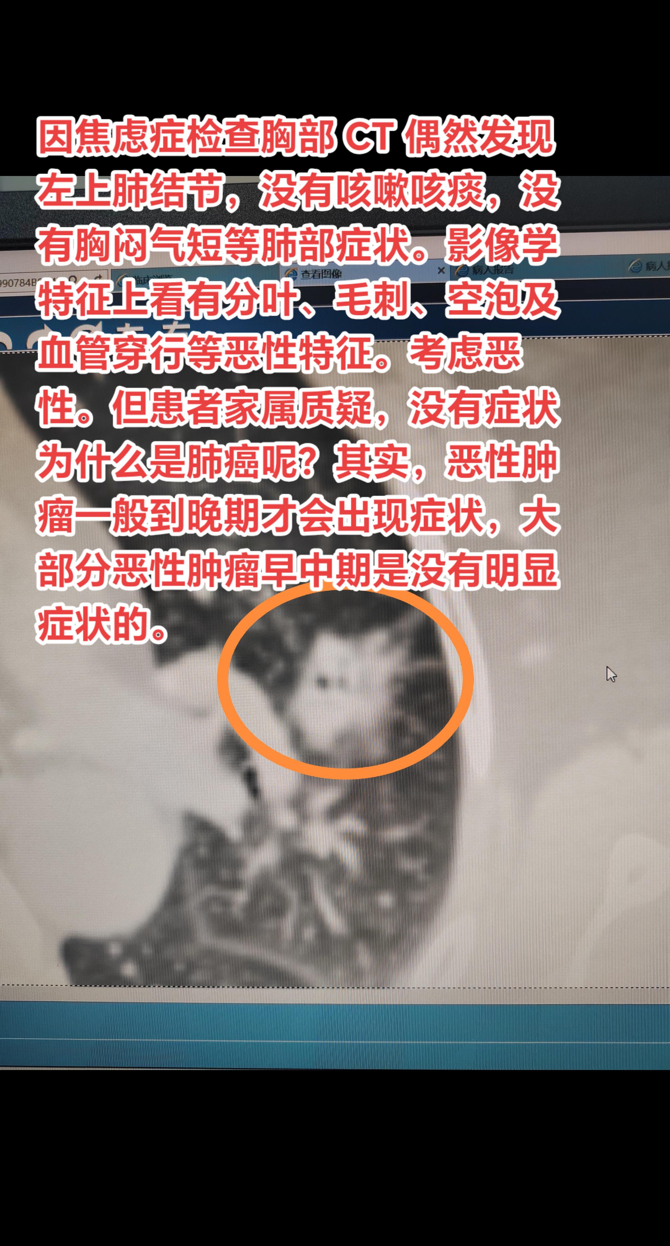 肺结节没有症状就不会是癌吗？因焦虑症检查胸部 CT 偶然发现左上肺结节...