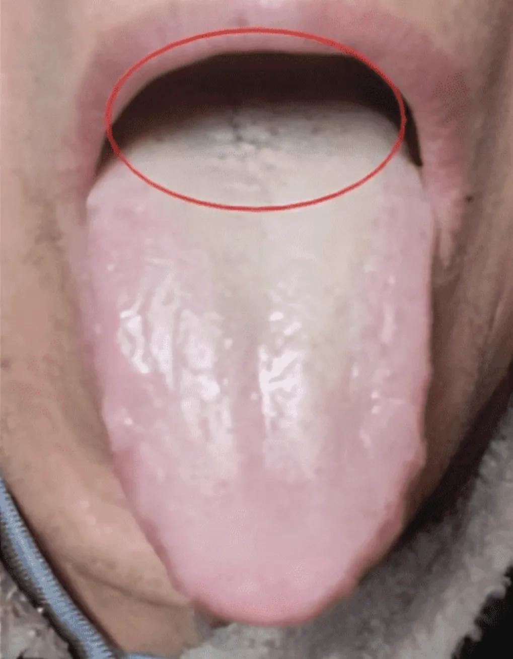 出现黄苔，千万不要用苦寒药去清热，因为它不是上火而是郁热！

患者早上感觉口苦口