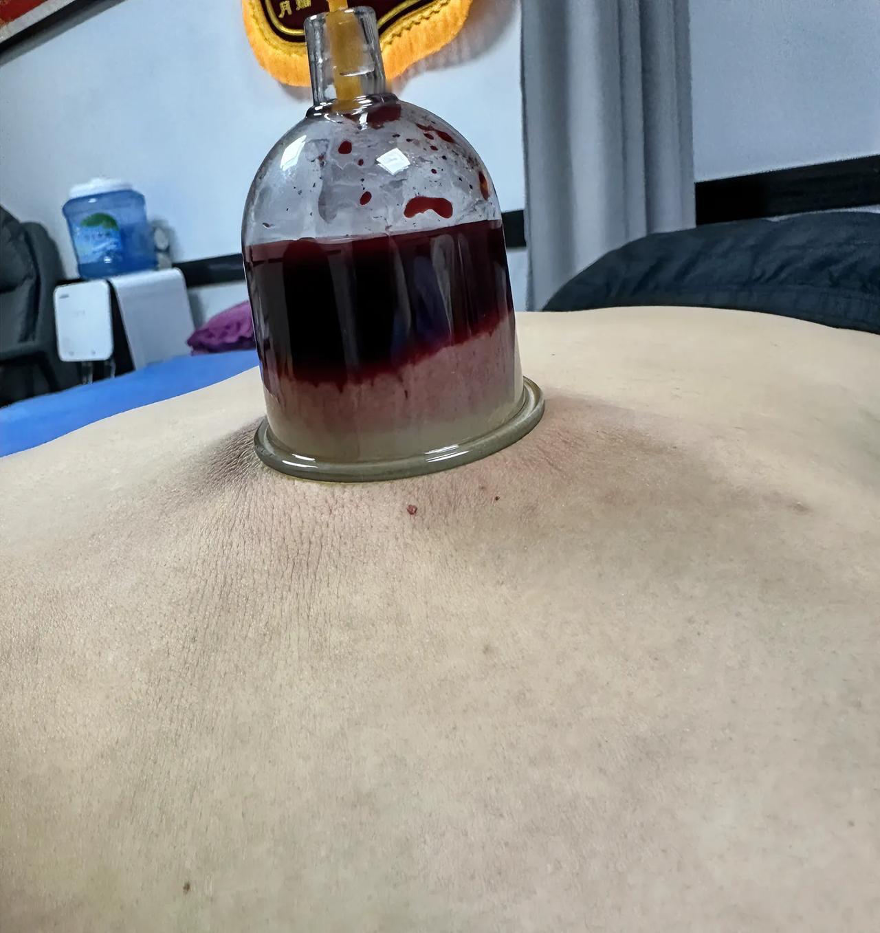 又跑去被放血了。
受常年性过敏性鼻炎的困扰，
这不又听人介绍去了一家社区门诊，
