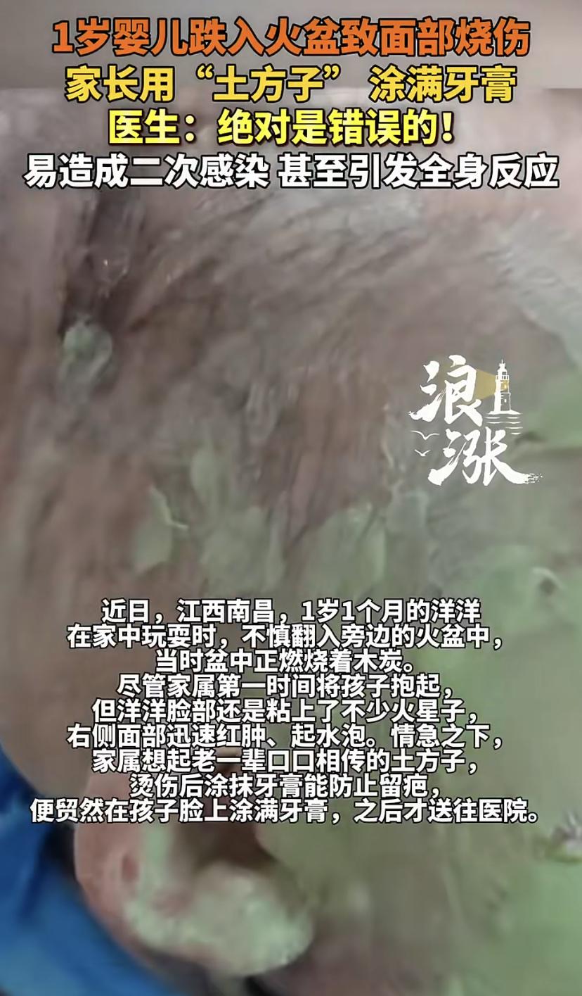 1岁宝宝栽进火盆脸烧伤!家长一个操作，医生急了：更严重了
南昌1岁1个月的洋洋不