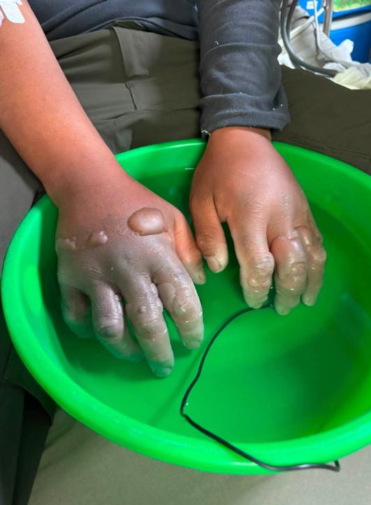 尼泊尔向导达瓦·努尔布·夏尔巴（Dawa Nurbu Sherpa）的双手被冻伤