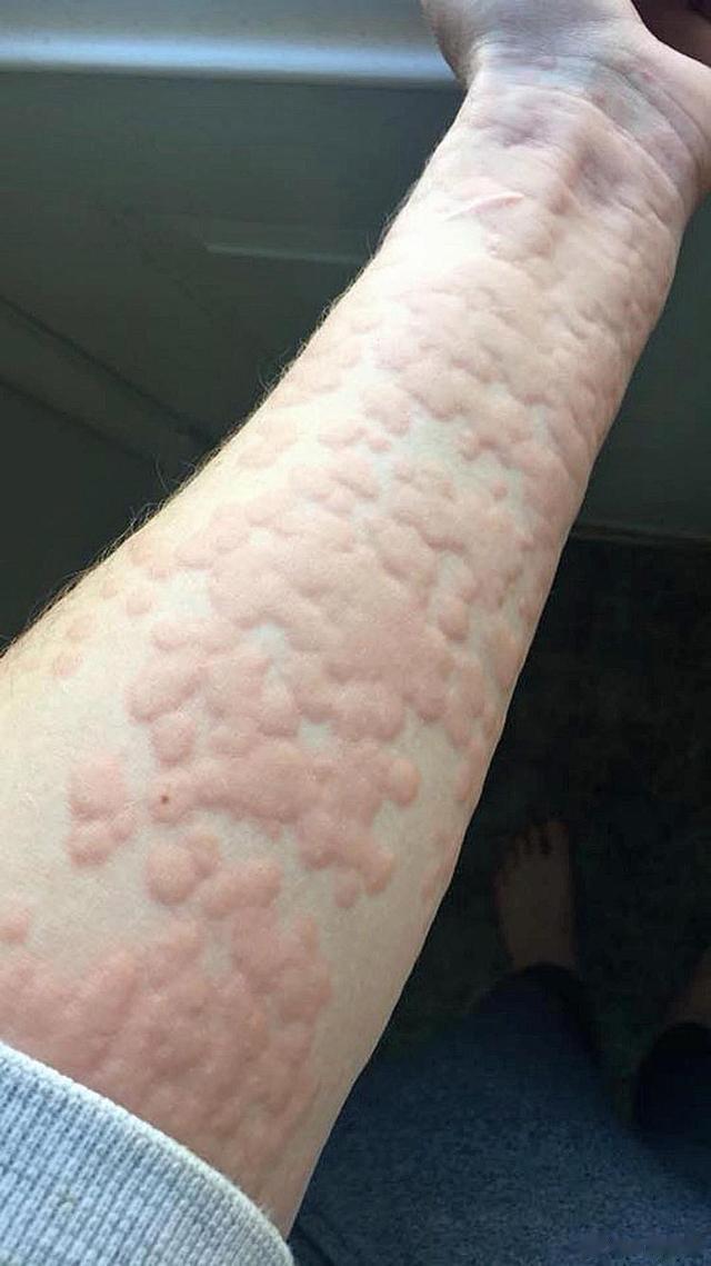 过敏煎，专治各种皮肤过敏，就问你服不服？过敏，说到底还是自身问题，免疫力低下，对