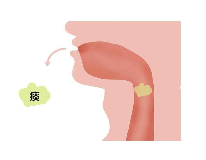 痰多吐不完？记好小青龙除白痰，麻杏石甘化黄痰，半夏厚朴清粘痰
常觉嗓子眼痰多吐不