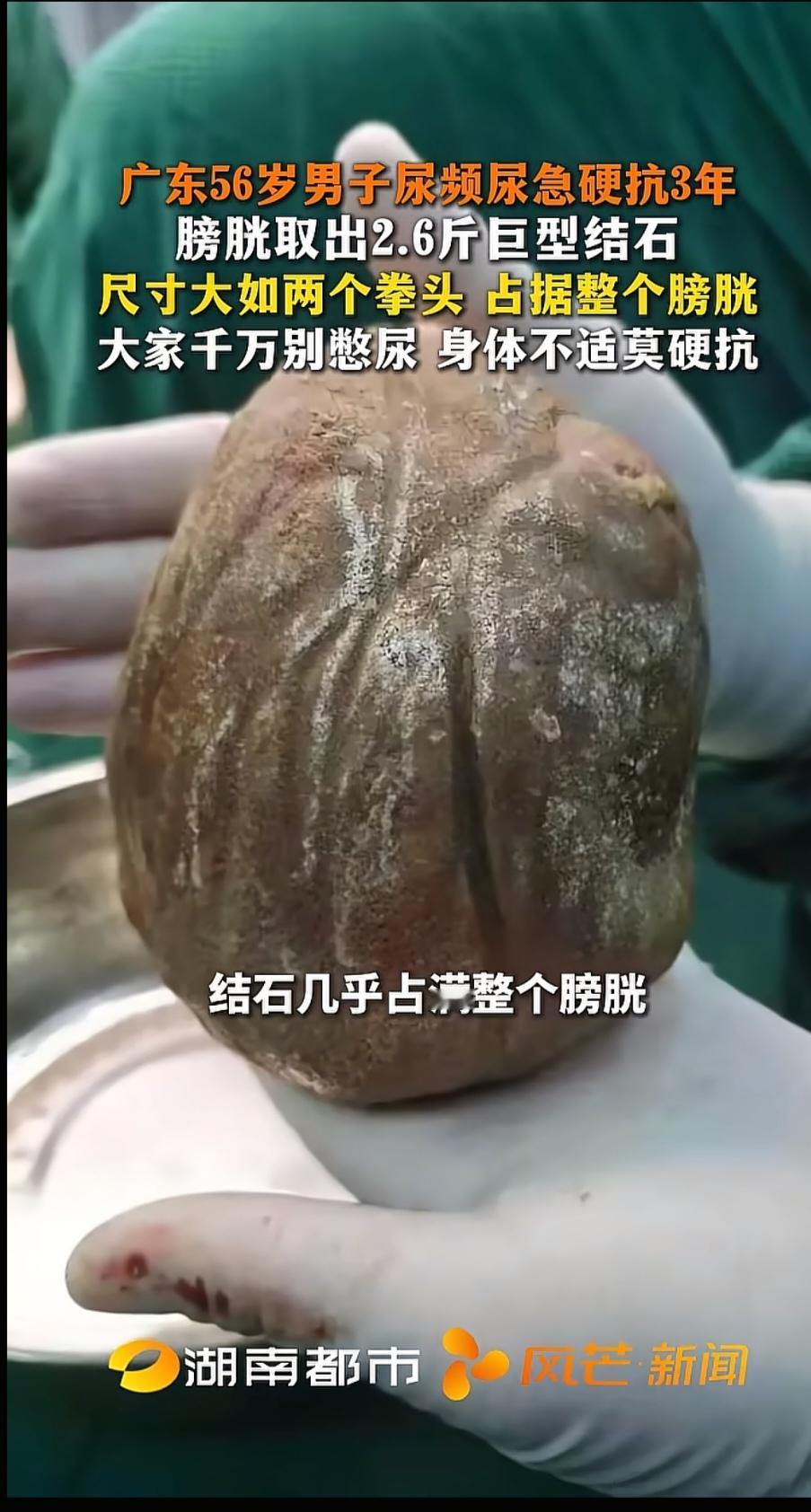 5月18日报道，广东，一男子饱受尿频困扰，晚上睡觉得起夜三四次，白天也不敢出远门