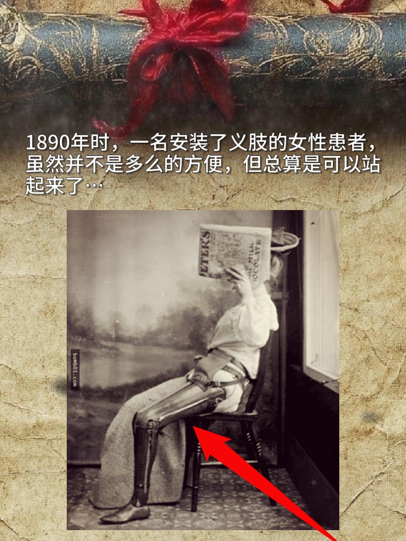 1890年时，一名安装了义肢的女性患者虽然并不是多么的方便，但总算是可...