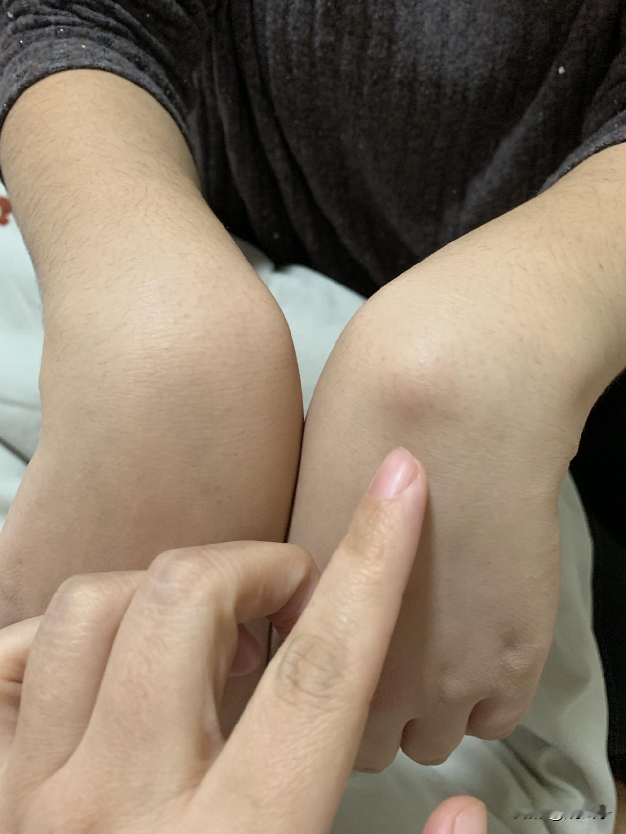 老天爷啊，这是腱鞘囊肿吧！女儿这周回来说手腕有点不对劲，摸着硬硬的一个鼓包，也不