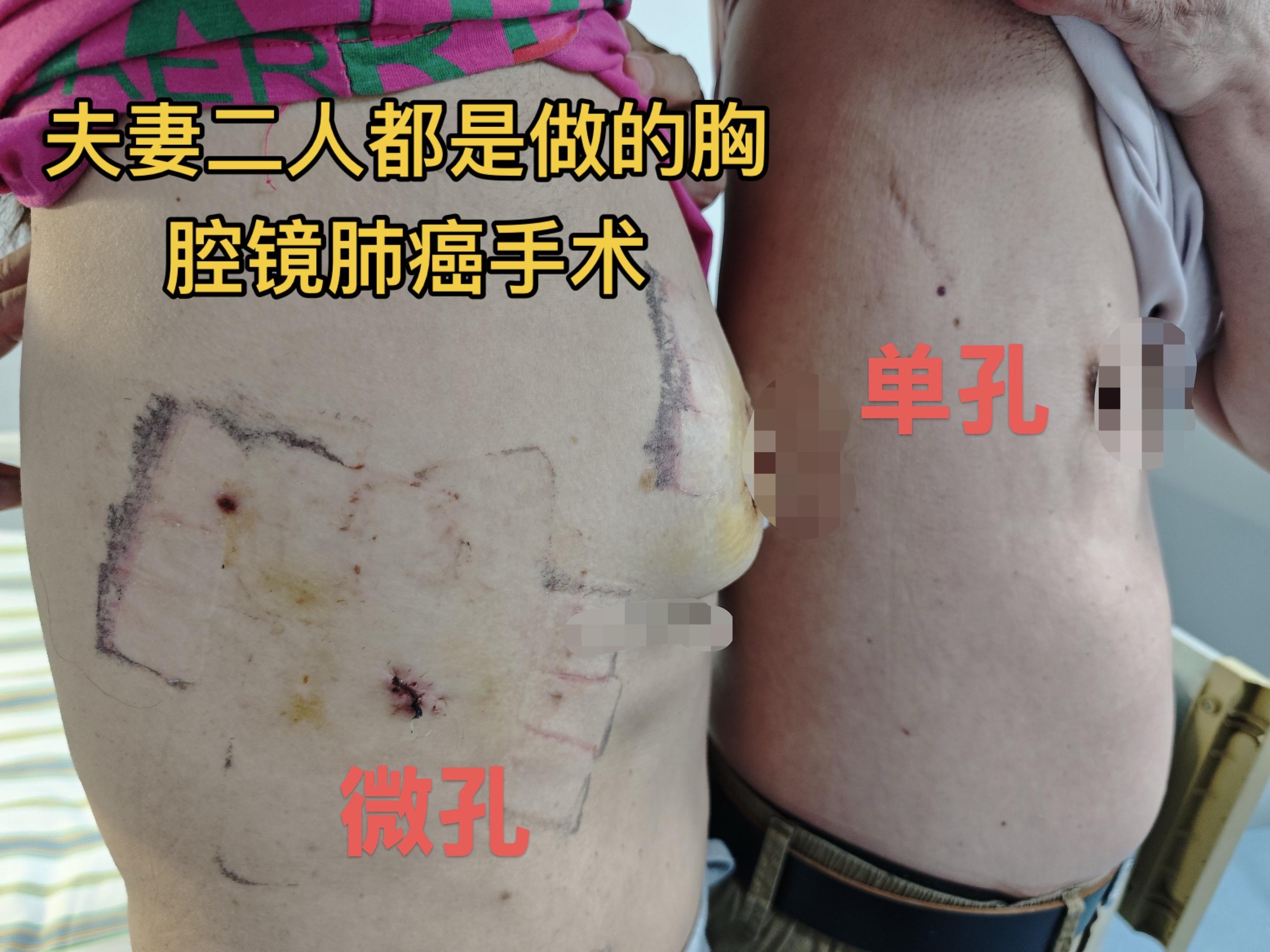 夫妻二人同样肺癌切除，区别咋这么大咧😀。今日查房病例。夫妻二人，丈夫...