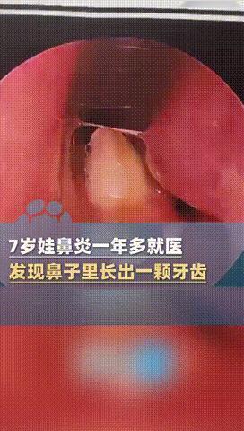 “过于离谱！”河南，7岁男孩患上鼻炎1年半，因为难受得不行，家长便带他去医院检查
