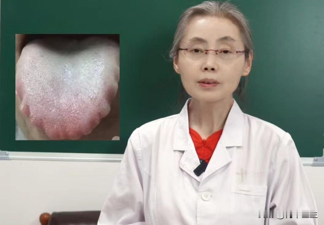 舌上一圈齿痕，别急着祛湿，根源可能在舌苔上

这个患者主诉是容易拉肚子，消化不好