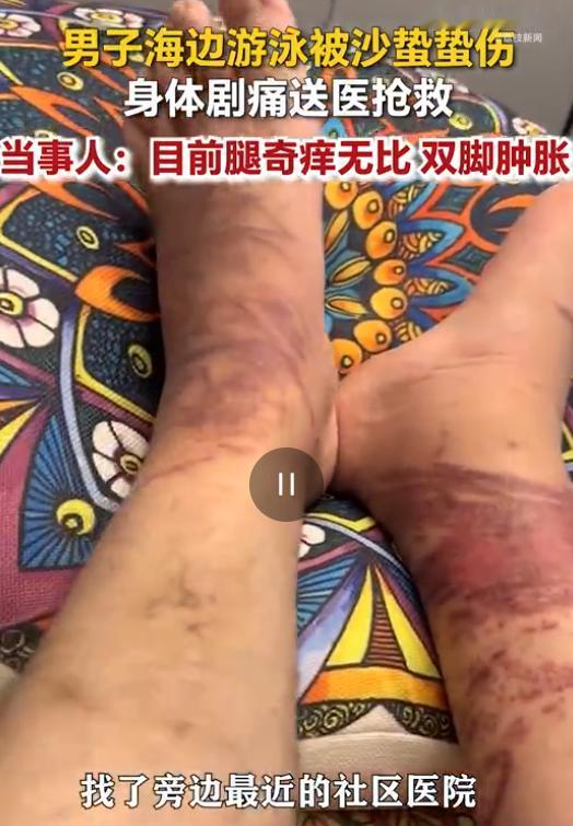 山东日照，男子下海游泳，万万没想到在浅水区突然遭遇了水下“隐形杀手”，当场像触了