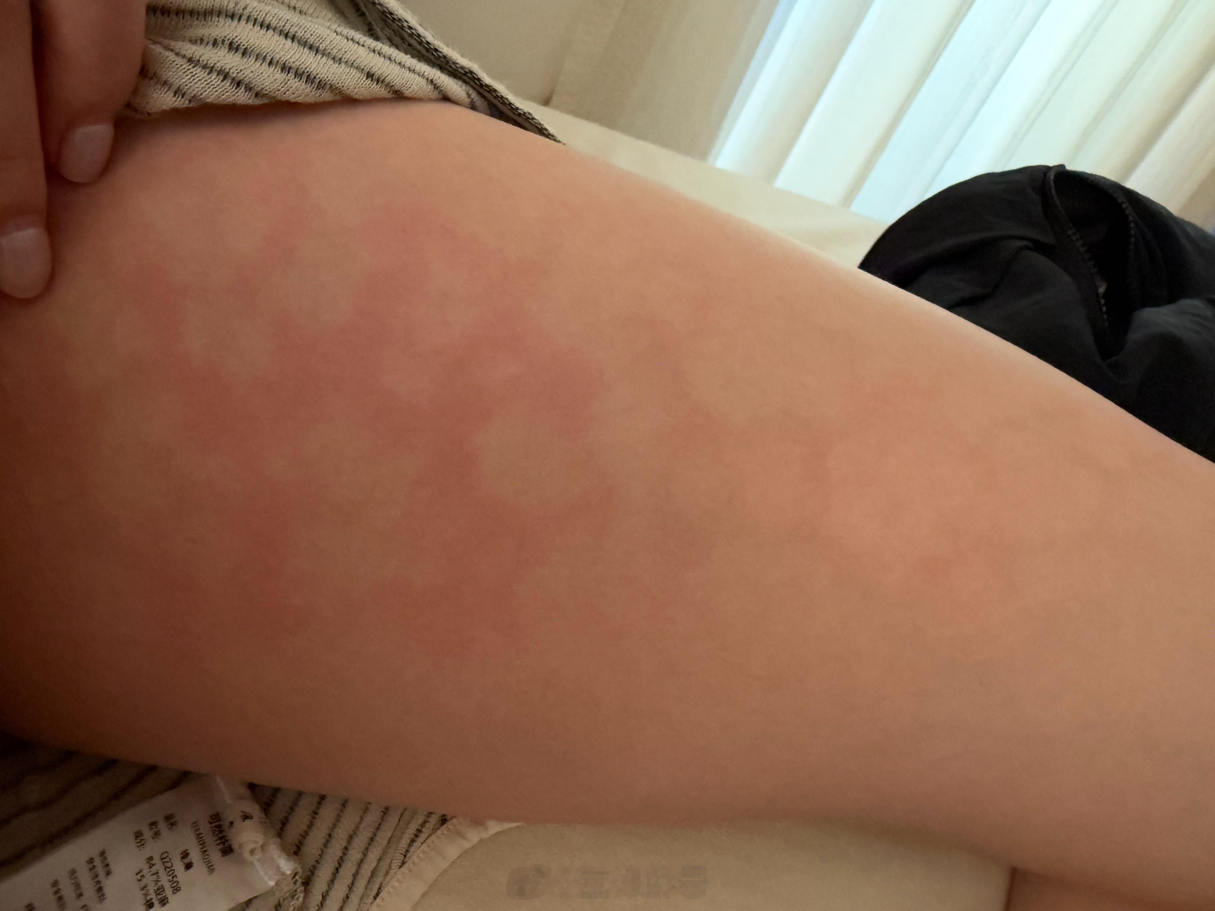 我去艾灸发现大腿居然灸出花纹了哈哈哈哈太搞笑了 ​​​