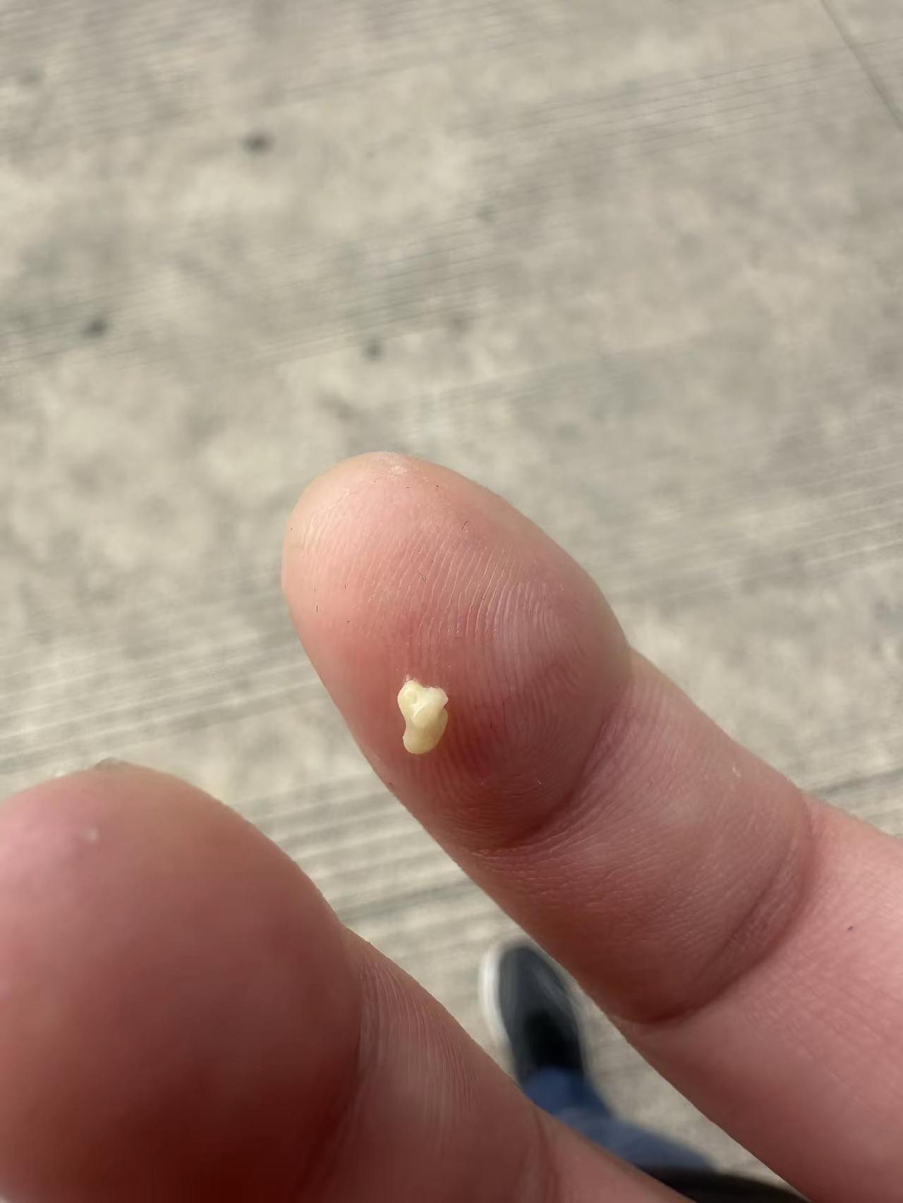 小伙得了这病