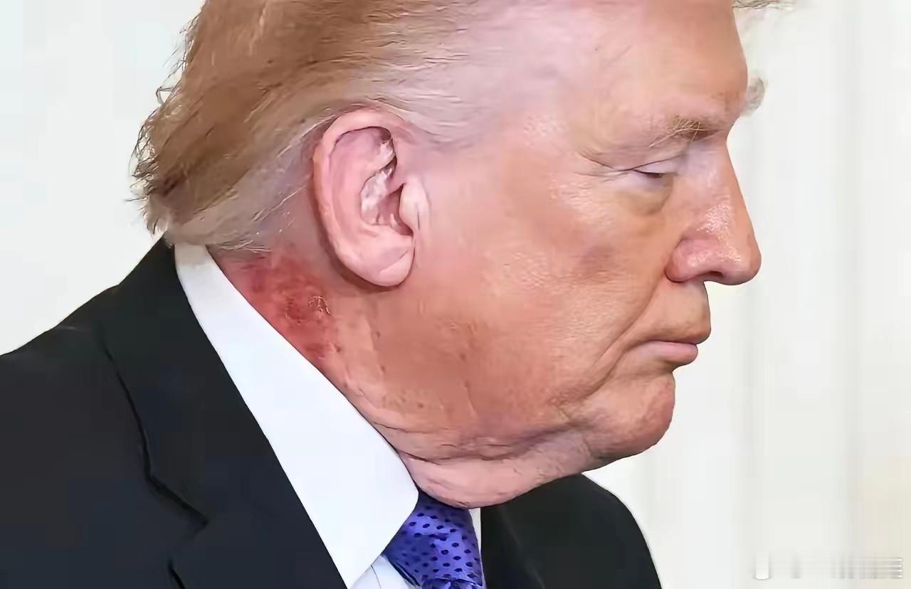 特朗普最新状态确实引人担忧，让不少网友吓一跳，皮肤呈现不正常的斑痕。有网友说：“