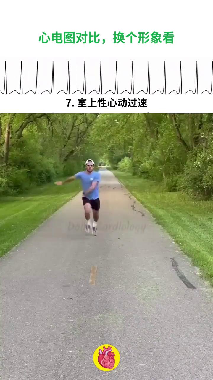 心电图对比，换个形象看。
·1.正常窦性心律。
·2.窦性心动过缓。
·3.窦性