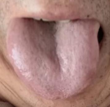 湿热下注扰动固摄，长痘潮湿体质完整辨证调理






前段时间有位男士私信咨询