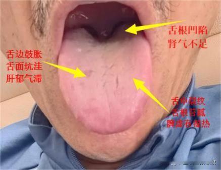 你不好好对待身体，身体怎么正反馈给你？[擦汗][擦汗]
中医解析舌象三大问题：肝